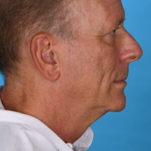 before rhinoplasty right side view male patient case 8442