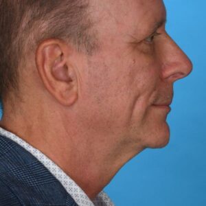 after rhinoplasty right side view male patient case 8442