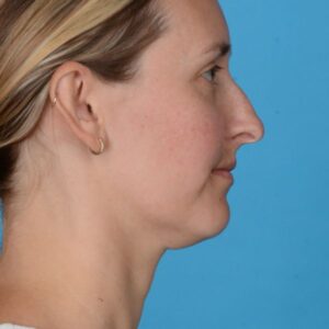 before rhinoplasty right side view female patient case 8423