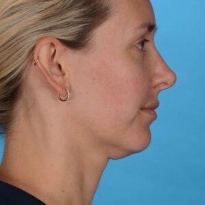 after rhinoplasty right side view female patient case 8423