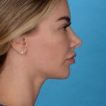 before rhinoplasty right side view female patient case 8446