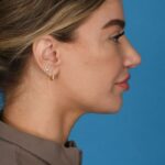 after rhinoplasty right side view female patient case 8446