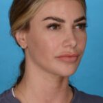 before rhinoplasty right side female patient case 8446