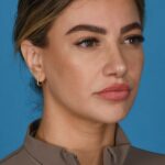 after rhinoplasty right side female patient case 8446