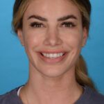 before rhinoplasty front view female patient with smile case 8446