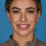 after rhinoplasty front view female patient with smile case 8446