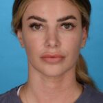 before rhinoplasty front view female patient case 8446