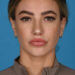 after rhinoplasty front view female patient case 8446