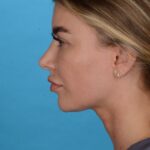 before rhinoplasty left angle female patient case 8446