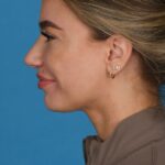 after rhinoplasty left angle female patient case 8446