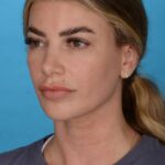 before rhinoplasty left angle female patient case 8446