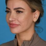 after rhinoplasty left angle female patient case 8446