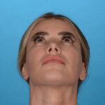 before rhinoplasty bottom view female patient case 8446