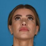 after rhinoplasty bottom view female patient case 8446