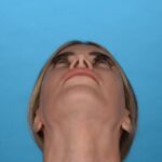 before rhinoplasty bottom view female patient case 2nd 8446