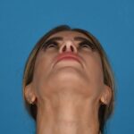 after 2nd rhinoplasty bottom view female patient case 8446