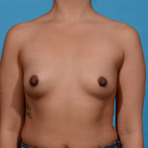 before breast augmentation with Dr. Yash front view case 9836