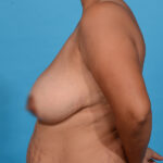 before breast lift with Dr. Yash side view case 9861