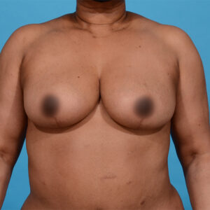 after breast reduction front view female patient case 9887