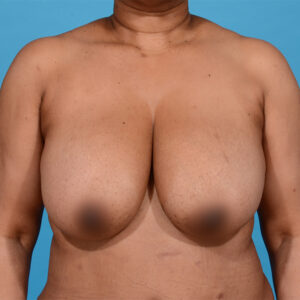 before breast reduction front view female patient case 9887